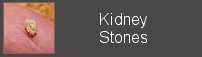 kinney stones