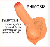 Phimosis- theme interpretation E / An abnormal tightness of the foreskin  preventing retraction over the glans Stock Photo